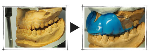 スポーツマウスピースのオーダーメイド せお歯科 大阪市淀川区 三国駅すぐの歯医者