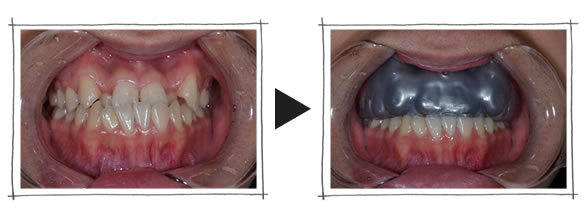スポーツマウスピースのオーダーメイド せお歯科 大阪市淀川区 三国駅すぐの歯医者